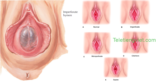 Cấu Tạo Màng Trinh Và Vị Trí Màng Trinh Của Con Gái